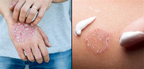 Eczema Vs Ringworm Symptoms Treatments And When To Seek Care