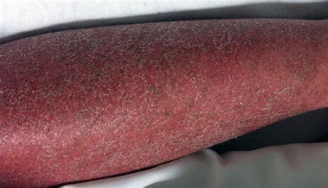 Derm Dx A Red Scaly Rash Covering The Entire Body Clinical Advisor