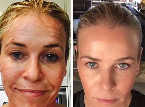 Chelsea Handler S Plastic Surgery Did She Have Any Cosmetic Enhancements