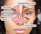 Severe Sinus Pain On Left Side Of Face Images