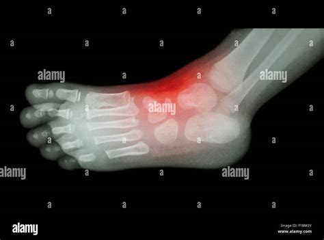 La artritis y la lesión en el tobillo película X ray de niño s vista lateral del pie