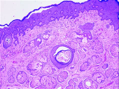 Numerous Lobules Of Sebaceous Glands Around Pilosebaceous Unit Hande X