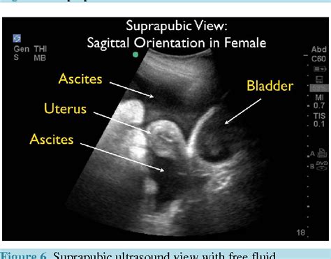 Figure 17 From Ultrasound For Detection Of Ascites And For Guidance Of