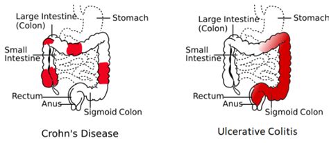 Ulcerative Colitis Wikem