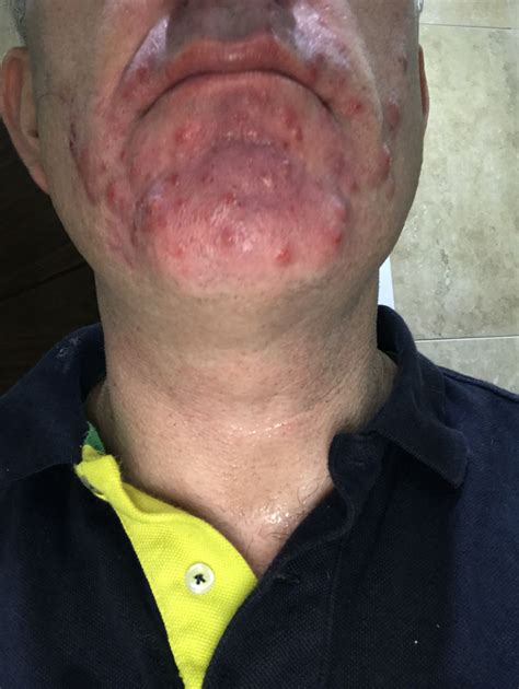 Vaping Caused Me Terrible Acne General Acne Discussion