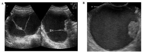 Atypical Endometriomas With Solid Papillary Projections A