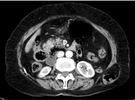 A Ct Scan Showed Herniation Of Retroperitoneal Fat And Descending Colon