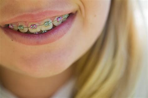 Convey More With Color What Colors Of Braces Should You Choose Nha Khoa Răng