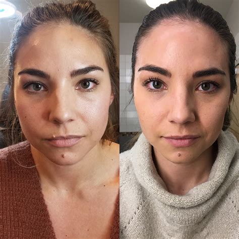 My Experience Receiving Botox For Tmj Lauryncakes