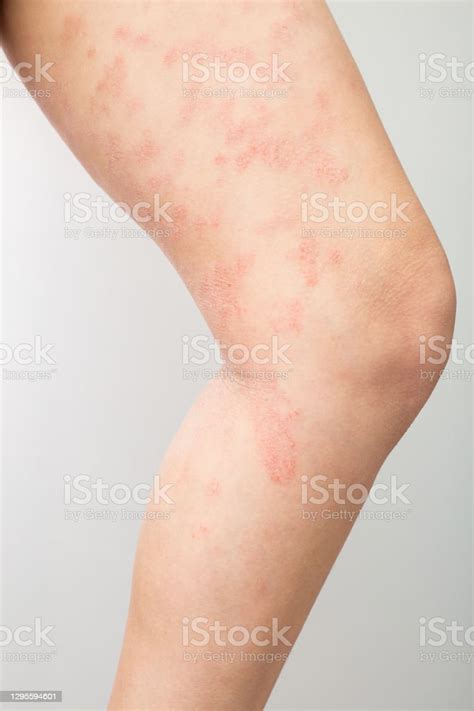 Acute Atopic Dermatitis On The Legs Of A Child Is A Dermatological
