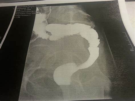 Непроходимость кишечника - Вопрос хирургу - 03 Онлайн Картинка - Непроходимость кишечника - Вопрос хирургу - 03 Онлайн