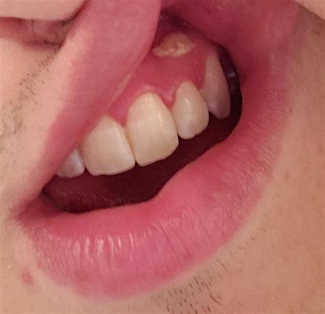 Any Thoughts On This White Bump On Upper Gum Mostly Painless Seems To