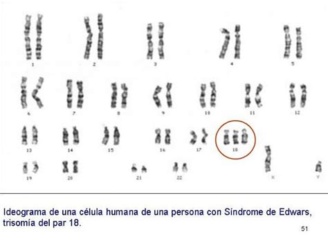 Edwards Syndrome Trisomy 18 Physiopedia