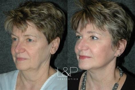 Facelift And Neck Lift Before And After Photos Case 20 Palo Alto And San