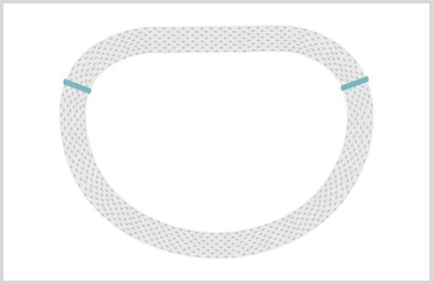 Mitral Valve Repair Edwards Lifesciences