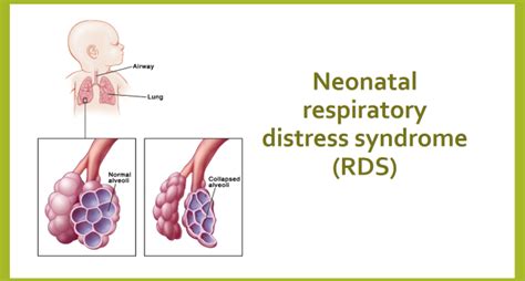 Rds Syndrome Overview Of Current Lung Imaging In Acute Respiratory