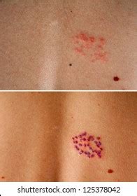 Literature review on the issue of 6th type herpes study was presented. Herpes Zoster Images, Stock Photos & Vectors | Shutterstock