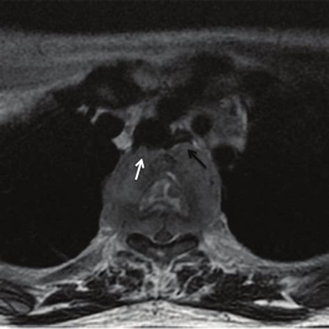 Axial T2 Fat Suppressed Mr Image At The Level Of T3 Showing A