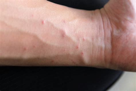 All You Need To Know About The Recent Spread Of Scabies