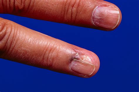When Melanoma Hides Woman Develops Skin Cancer Under Her Nail