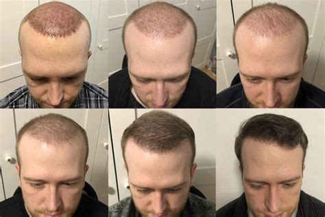 Wachstum Nach Haartransplantation Nach Monaten Erstes Ergebnis