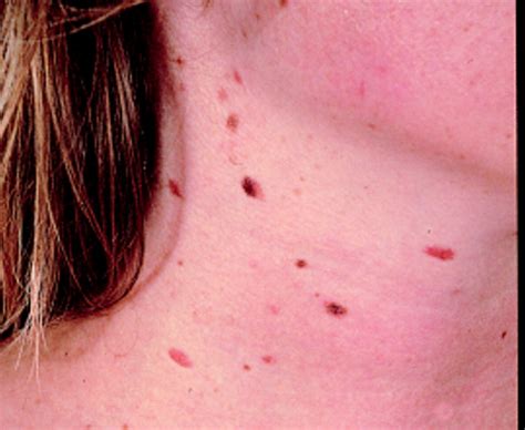 Size Of Moles Linked To Melanoma Risk The Bmj