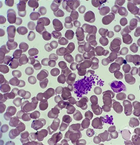 Clumps Of Platelets In Peripheral Blood Smear