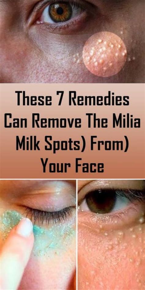 These 7 Remedies Can Remove The Milia Milk Spots From Your Face