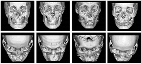 IBIMA Publishing A New Classification of Zygomatic ...