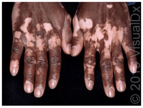 Spotting The Diagnosis Of Vitiligo Visualdx