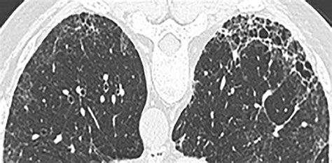 Ct In Idiopathic Pulmonary Fibrosis Diagnosis And Beyond Ajr