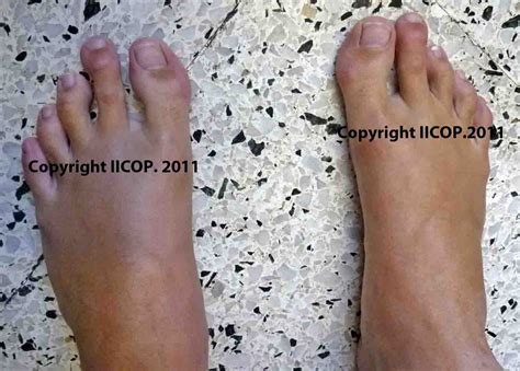 Acortamiento de los dedos del pie más innovación en Cirugía Estética
