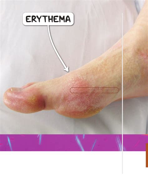 Rheumatoid Arthritis Osmosis