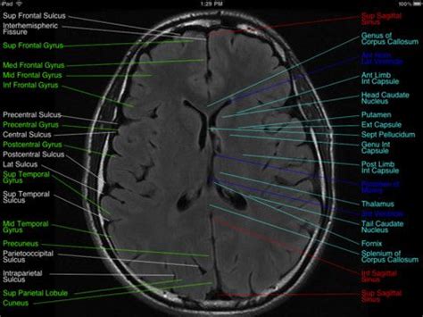 Depending on the scanner, transversal images may be reconstructed in the. Pin by Jane Hwang on Neuro | Mri brain, Mri study, Mri