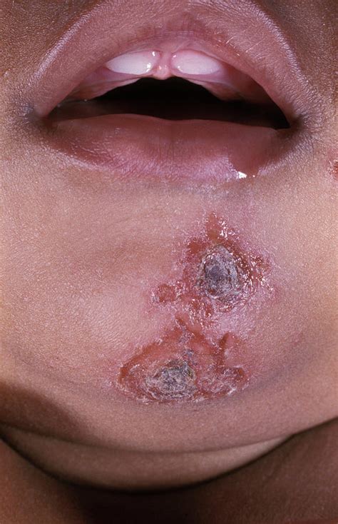 Impetigo Skin Infection Photograph By Dr Ma Ansaryscience Photo Library