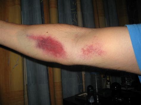What Causes Bruising After Blood Test