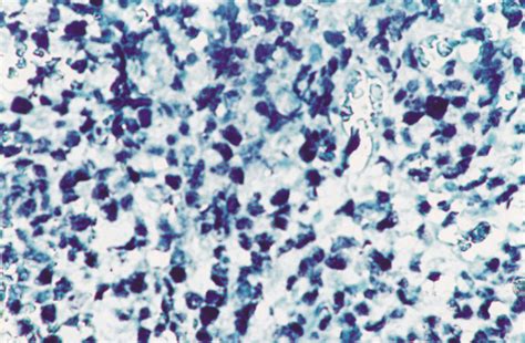 Primary Gastric Diffuse Large B Cell Lymphoma With Malt Component