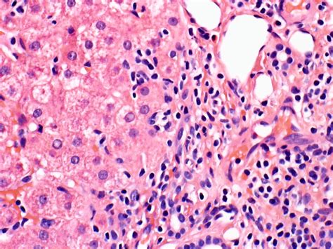 Pathology Outlines Chronic Hepatitis Grading Staging