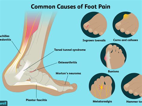 Top Foot Pain Diagnosis Chart Best Picture Of Chart Anyimageorg