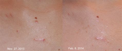 Keloid Treatment Keloid Removal Expert New York