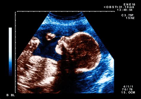 fetuses react to face like patterns shots health news npr