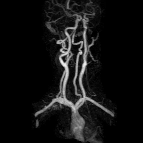 Origin the right common carotid artery originates behind the sternoclavicular. MRA Bilateral Carotid stands for magnetic resonance ...