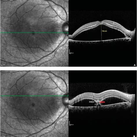 A Spectral Domain Optical Coherence Tomography Of The Right Eye
