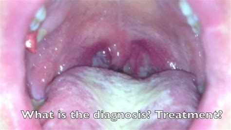 Clinical Quiz Sore Throat Youtube