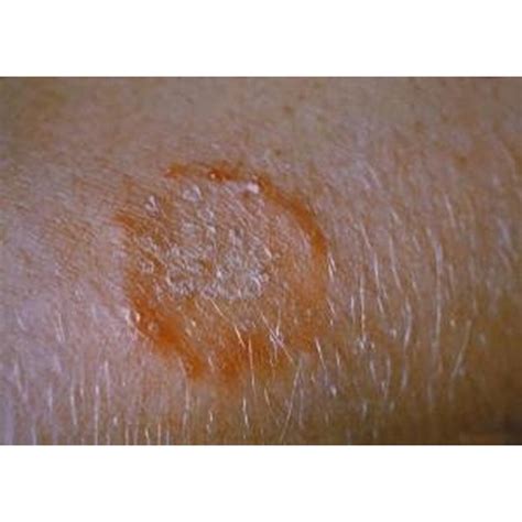 Developmental Stages Of Ringworm Healthfully