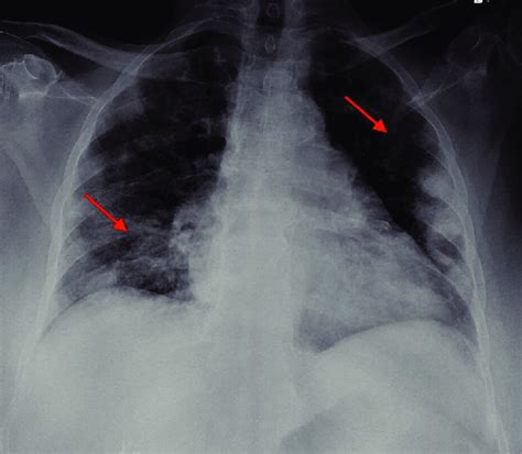 Posteroanterior Chest X Ray Showed No Infiltrate Effusion Or