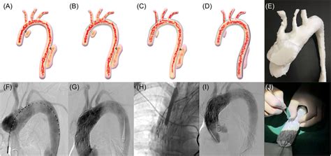 A F Digital subtraction angiography DSA revealed a 5 0 3 4 cm²