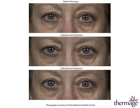How Long Do Thermage Results Last Radiance Skincare And Laser Medspa