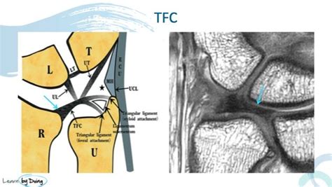 Mri Wrist Tfcc Anatomy Radedasia