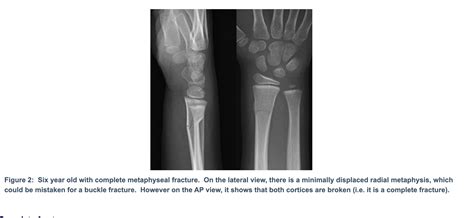 Greenstick Fracture X Ray